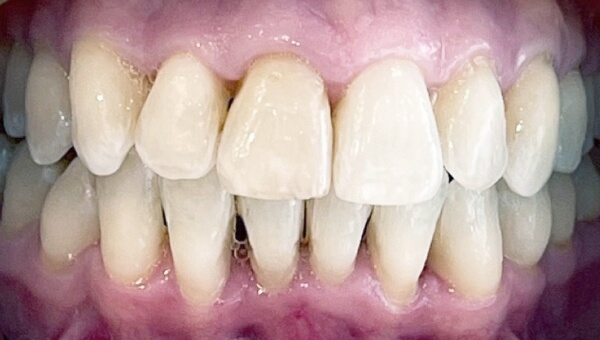 Gerade Zähne nach Invisalign® Anwendung bei HarschDental Zahnarztpraxis