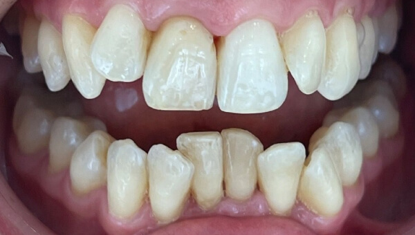 Schiefe Zähne vor Invisalign® Anwendung